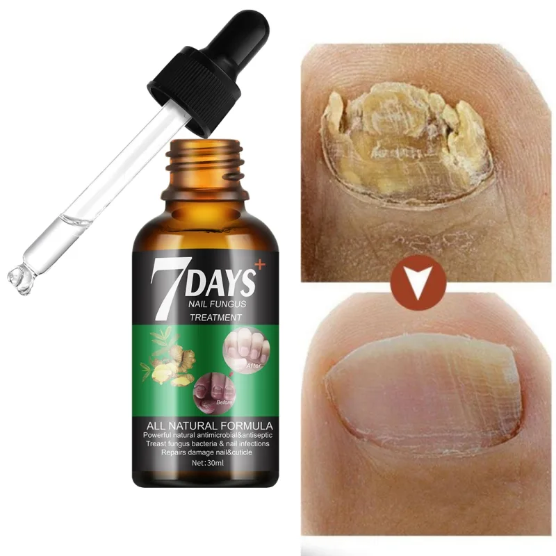 7 DAYS Nail Fungus Treatment Liquid